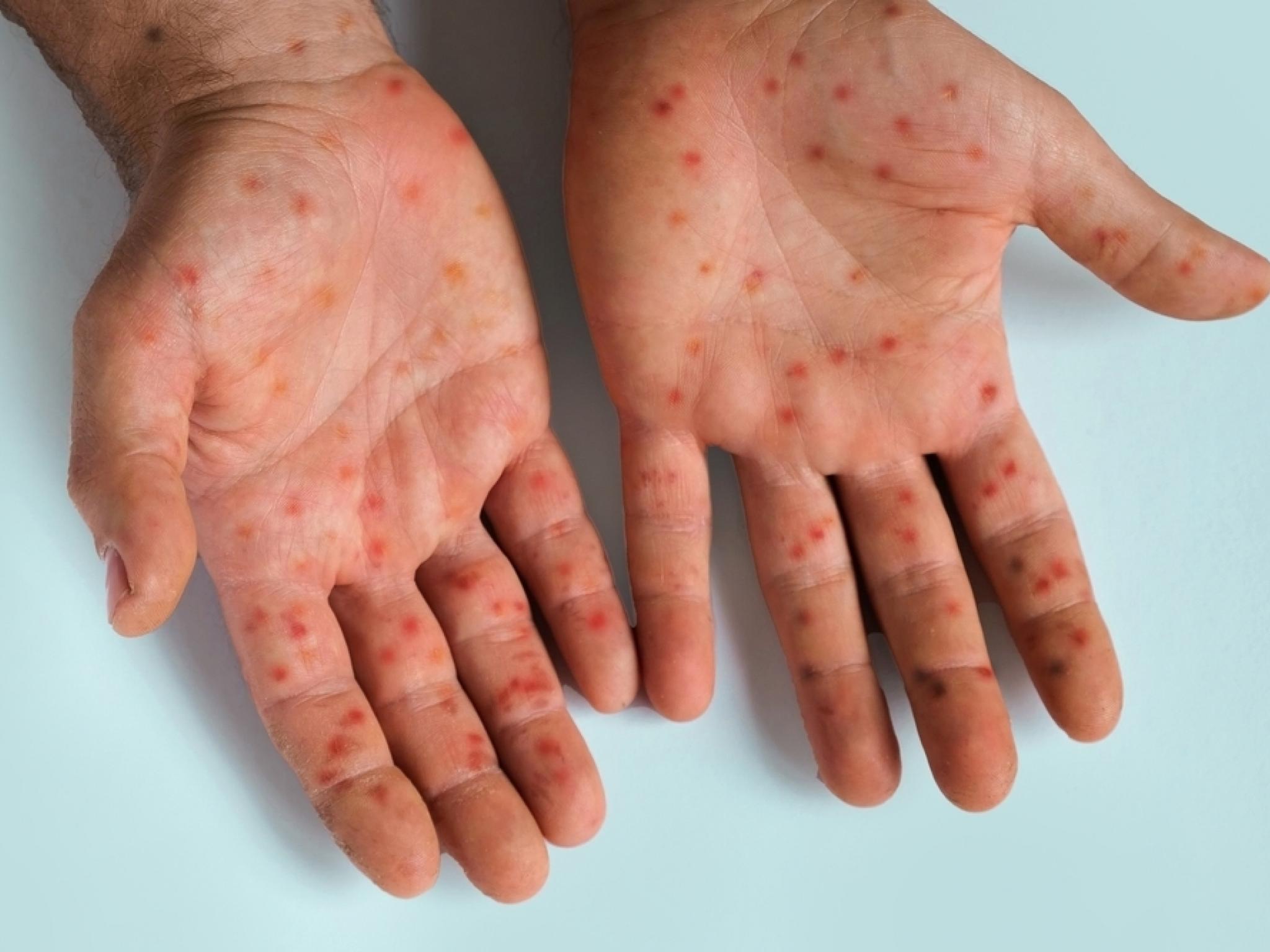 Apogee Therapeutics’in ilacı klinik denemede başarılı oldu